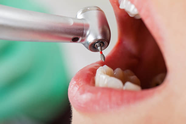 Best Emergency Treatment for Dental Infections or Abscesses in Imperial Beach, CA